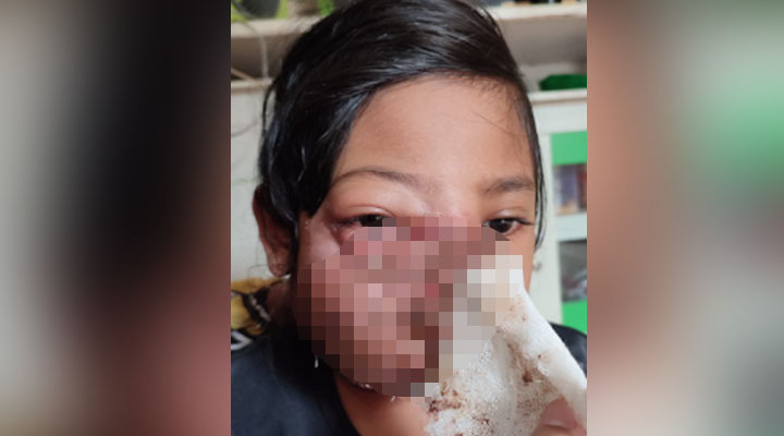 Setahun Idap Tumor di Wajah, Bocah 7 Tahun Asal Nagrak Sukabumi Butuh Bantuan