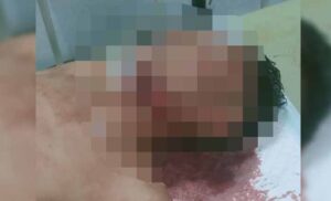 Tertabrak Setelah Jatuh dari Motor, Warga Surade Alami Luka Serius