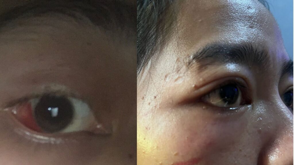 Diduga Dianiaya Mantan Kekasih, Seorang Wanita Muda di Sukabumi Alami Kekerasan Brutal