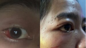 Diduga Dianiaya Mantan Kekasih, Seorang Wanita Muda di Sukabumi Alami Kekerasan Brutal